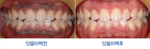 잇몸미백 전/후